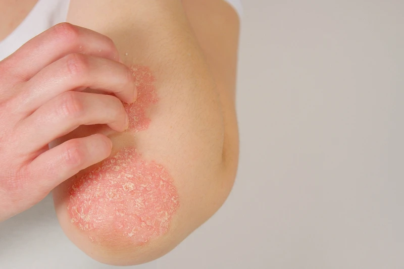 Di truyền là một trong những yếu tố gây bệnh vảy nến