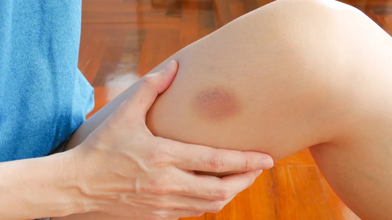 Vết bầm chuyển sang màu vàng có sao không? Cách khắc phục tình trạng này 1