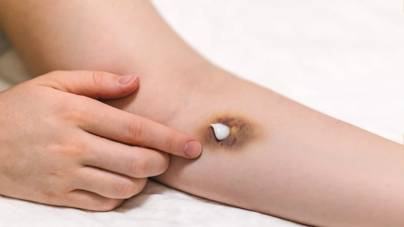 Vết bầm chuyển sang màu vàng có sao không? Cách khắc phục tình trạng này 4