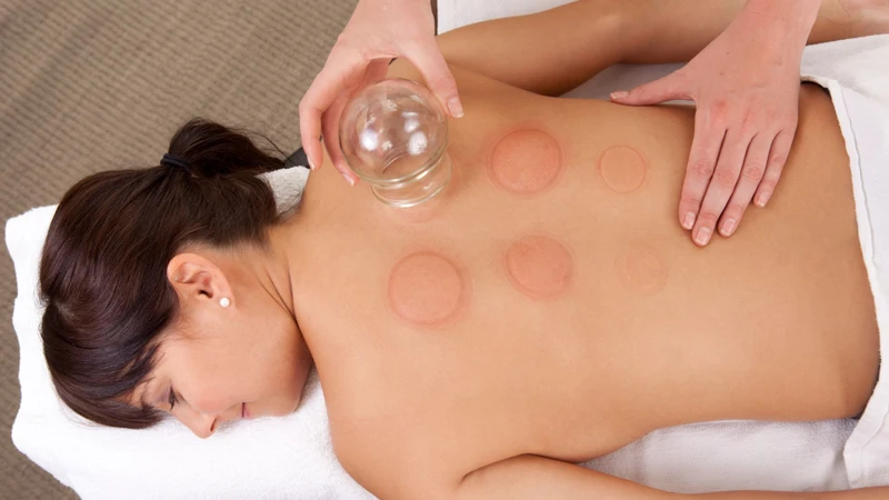 Quá trình giác hơi tạo áp lực âm khiến mạch máu nhỏ dưới da vỡ nhẹ, hình thành vết bầm tạm thời