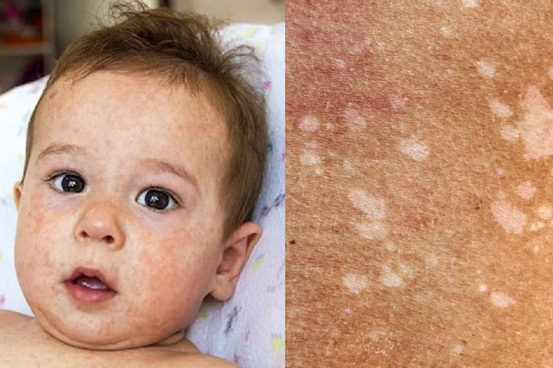 Vết loang trắng trên da trẻ sơ sinh là bị gì? Các bệnh da liễu liên quan đến vết loang trắng 1