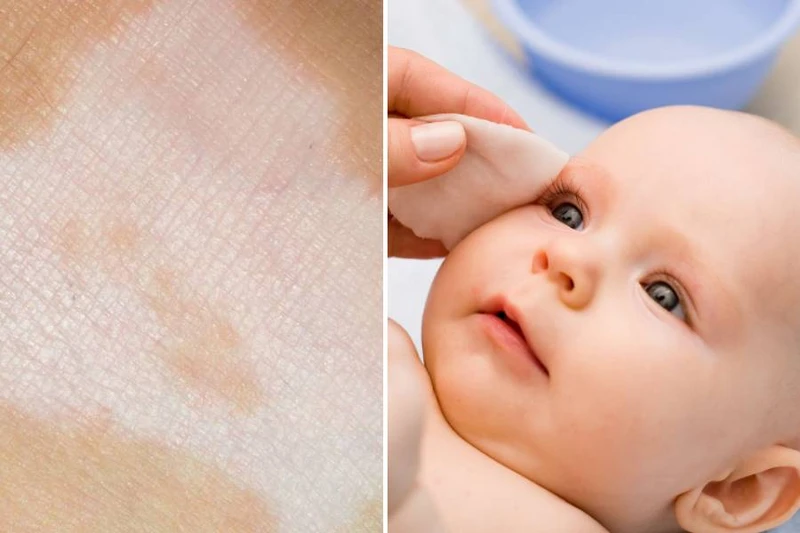 Vết loang trắng trên da trẻ sơ sinh là bị gì? Các bệnh da liễu liên quan đến vết loang trắng 2
