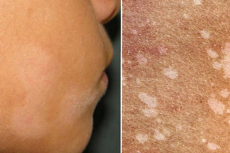 Vết loang trắng trên da trẻ sơ sinh là bị gì? Các bệnh da liễu liên quan đến vết loang trắng 3