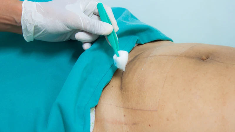 Vết mổ sau sinh bao lâu thì tắm được? Cách chăm sóc vết mổ sau sinh mổ để đảm bảo an toàn khi tắm 3