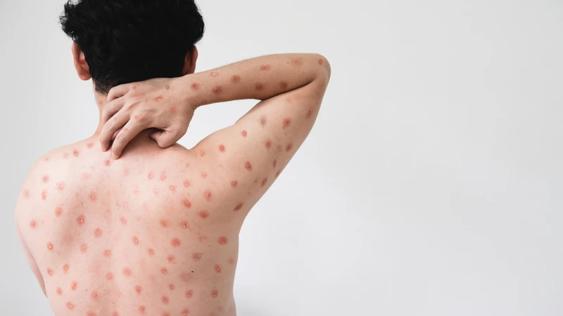 Hồng ban đa dạng cũng gây nhưng tổn thương tương tự, cần nhận biết phân biệt với các biểu hiện bệnh lý da lành tính