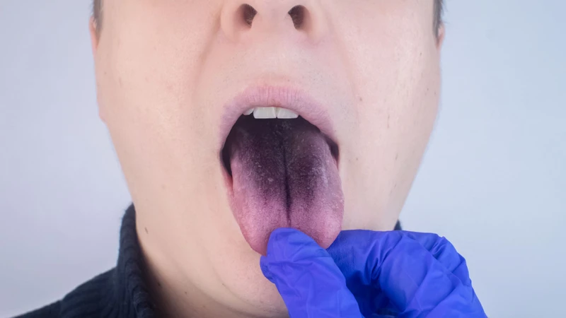 Lưỡi bị đen khi ăn lá mơ là do các sắc tố trong lá có thể bám lên bề mặt lưỡi