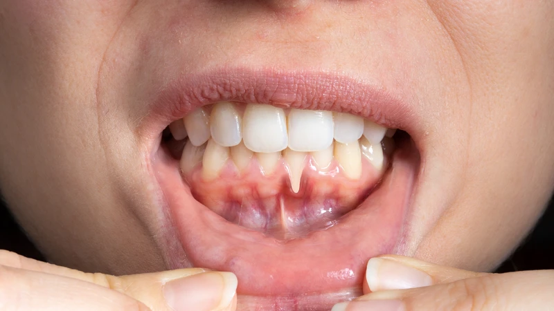 Viêm nướu khiến mô lợi đỏ, sưng và dễ chảy máu, đặc biệt khi đánh răng hoặc vệ sinh răng miệng không đúng cách