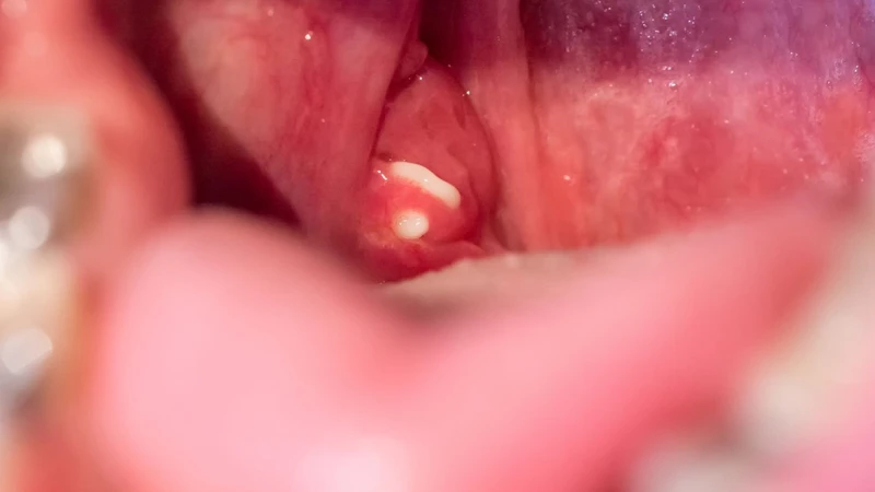 Viêm amidan 1 bên là tình trạng viêm nhiễm, tổn thương chỉ xảy ra ở một bên amidan