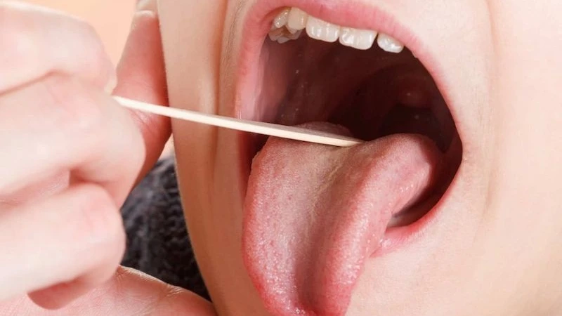 Viêm amidan 1 bên thường do nhiễm vi khuẩn, virus, hoặc là biểu hiện của bệnh lý hô hấp khác