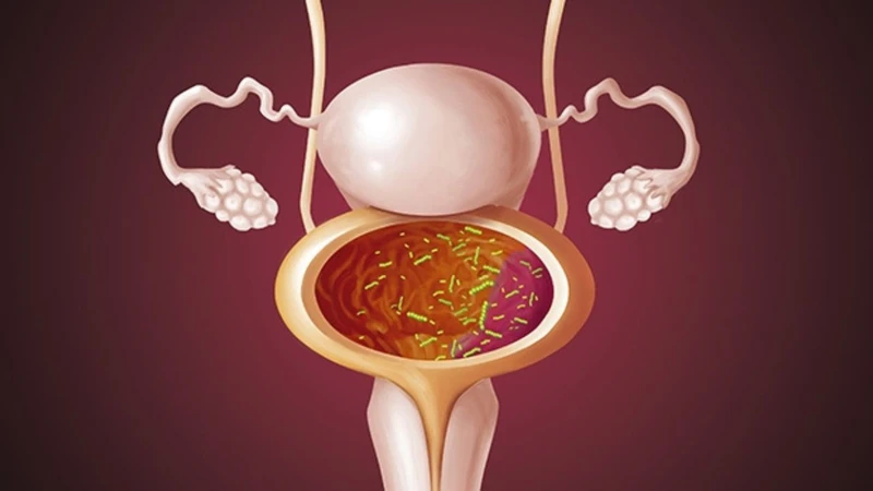 Viêm bàng quang là gì? Những điều cần biết 2.jpg