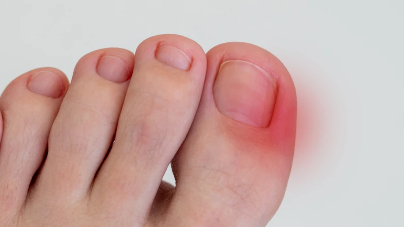 Vận động quá sức khiến ngón chân cái chịu tải lớn trong thời gian dài