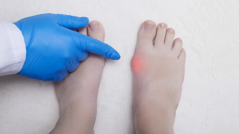 Mô liên kết yếu có thể gây viêm bao hoạt dịch ngón chân cái