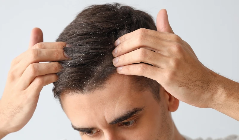 Gàu và viêm da tiết bã có thể gây bong vảy, rơi xuống mí mắt và dẫn đến viêm