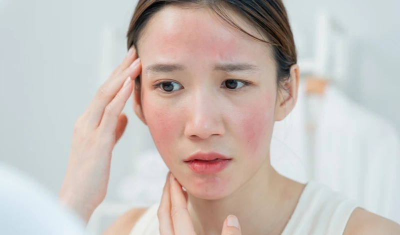 Viêm da, gàu hoặc mụn trứng cá đỏ có thể gây viêm và tắc tuyến nhờn ở mí mắt
