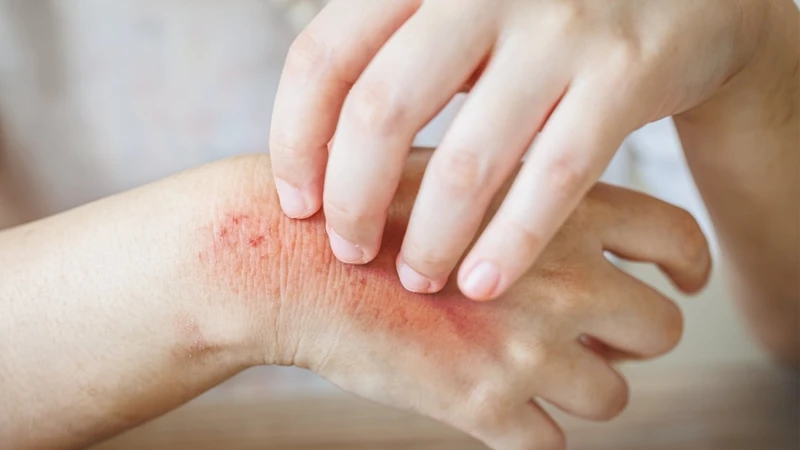 Viêm da cơ địa bội nhiễm khiến việc điều trị trở nên phức tạp hơn, da dễ tổn thương và để lại sẹo