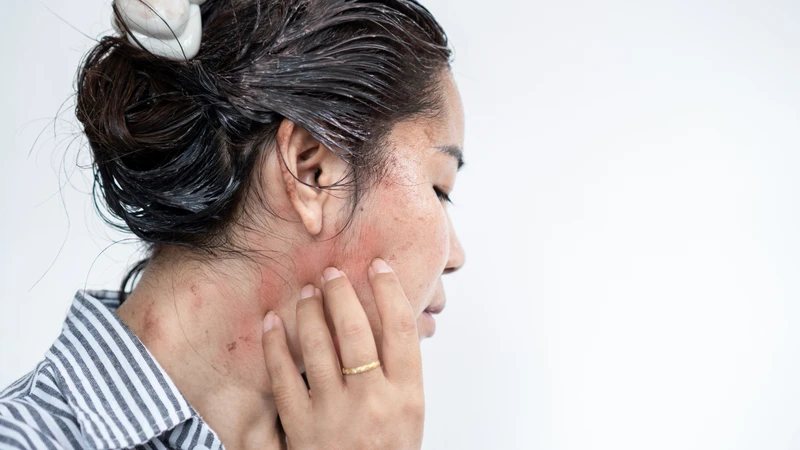 Viêm da tiếp xúc có lây không? Đây là thắc mắc phổ biến của nhiều người