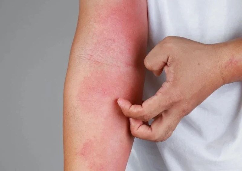 Da ở vùng bị kích ứng thường cảm giác bỏng rát, ngứa nhiều