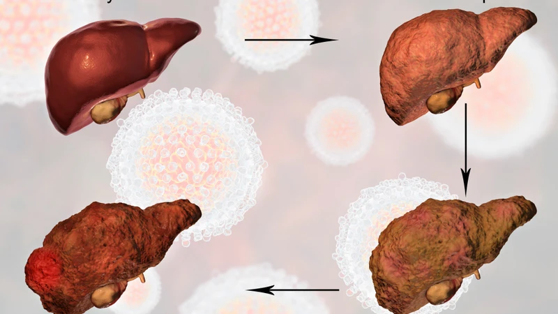 Trạng thái tái hoạt động của virus diễn ra trong âm thầm và lâu dài có thể dẫn đến viêm gan mạn tính, xơ gan nếu không được phát hiện