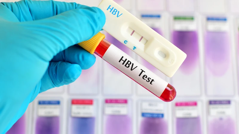 Xét nghiệm HBV DNA và tình trạng gan hỗ trợ quyết định điều trị