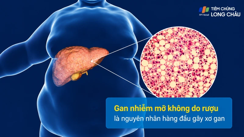 Viêm gan nhiễm mỡ không do rượu gây tích mỡ, viêm và tổn thương tế bào gan