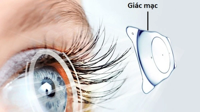 Viêm giác mạc và viêm kết mạc: Phân biệt để điều trị đúng 5
