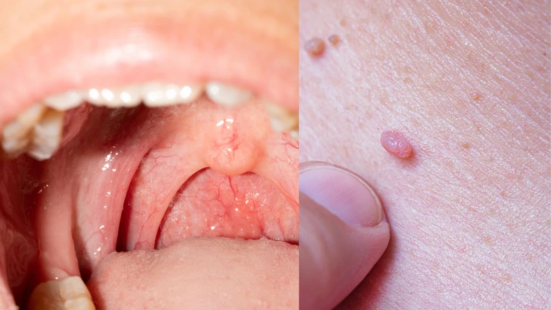 Viêm họng hạt và sùi mào gà: Phân biệt, điều trị và phòng ngừa hiệu quả 3