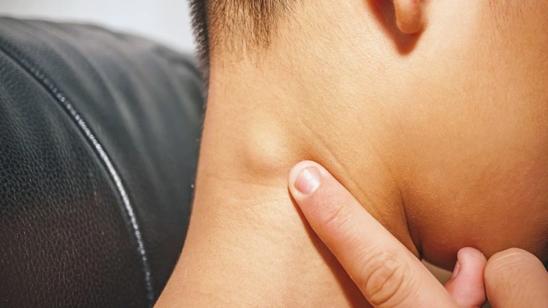 Viêm họng nổi hạch ở cổ: Nguyên nhân và cách điều trị 1