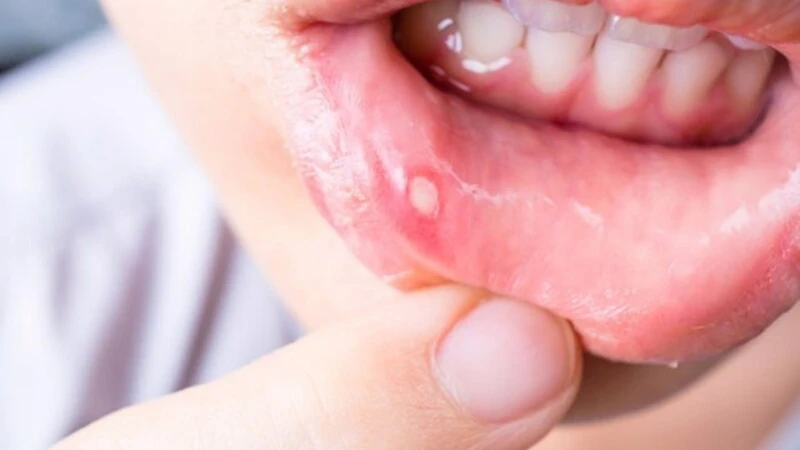 Viêm khoang miệng gây cảm giác đau hoặc khó chịu, có thể gây khó khăn khi ăn hoặc nói chuyện