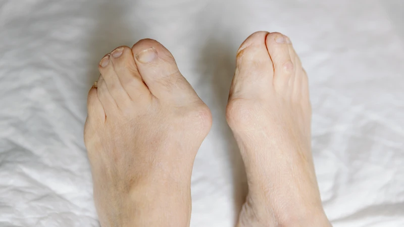 Nếu không thăm khám và điều trị thích hợp, viêm khớp có thể dẫn đến biến dạng khớp