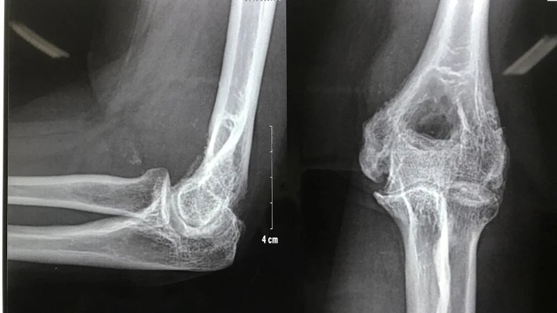 Viêm khớp nhiễm khuẩn là gì? Nguyên nhân, triệu chứng và cách điều trị 4.jpg