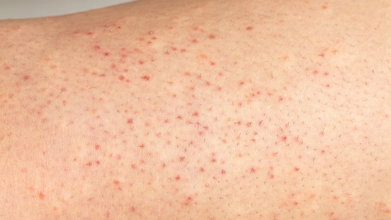Các vi sinh vật, đặc biệt là vi khuẩn tụ cầu hoặc một số loại nấm, có thể xâm nhập vào nang lông khi hàng rào bảo vệ da bị suy yếu