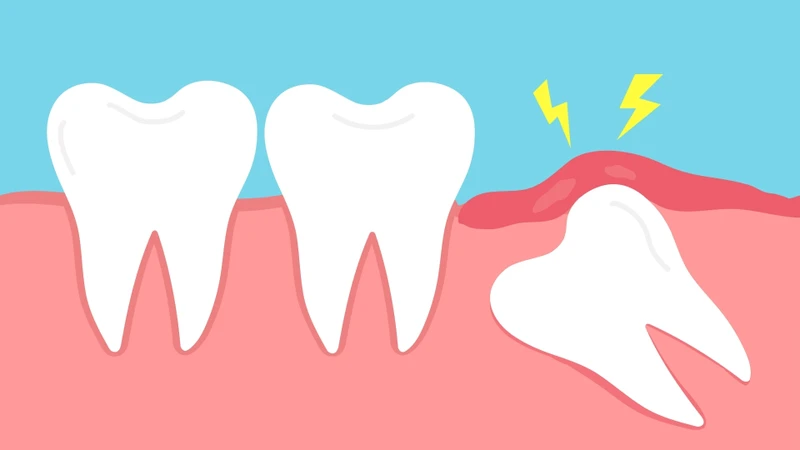 Viêm lợi trùm là tình trạng phần mô nướu (lợi) bao phủ một phần răng (thường gặp nhất ở răng khôn) bị viêm do vi khuẩn tích tụ dưới lớp lợi này