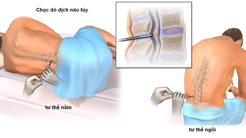 Viêm màng não do amip là gì Những vấn đề cần biết về Viêm màng não do amip 3.png