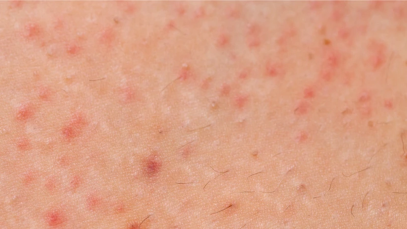 Viêm nang lông Malassezia thường gặp ở người có da dầu, đổ nhiều mồ hôi