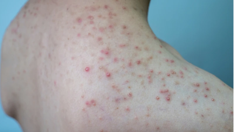 Xuất hiện mụn mủ nhỏ có thể là triệu chứng của viêm nang lông