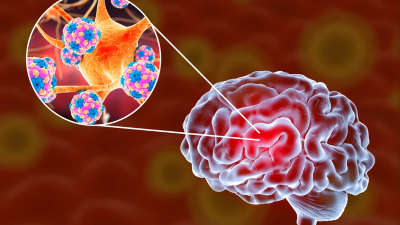 Viêm não do ve truyền có thể gây tổn thương nghiêm trọng đến hệ thần kinh trung ương