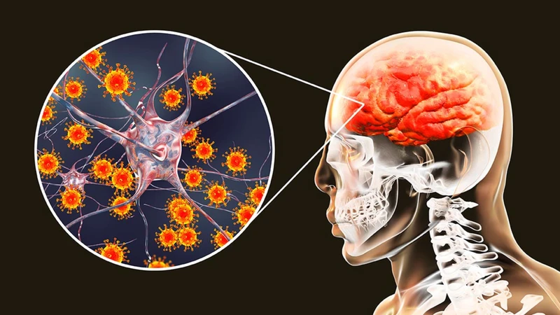 Bệnh nhân viêm não Nhật Bản cần được theo dõi và chăm sóc tích cực tại bệnh viện