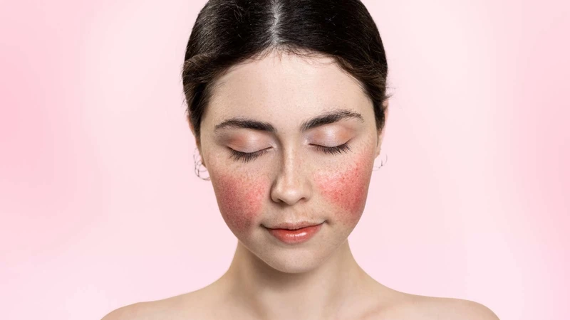 Người có bệnh tự miễn khác như lupus ban đỏ hệ thống có nguy cơ mắc phải viêm não tự miễn cao hơn