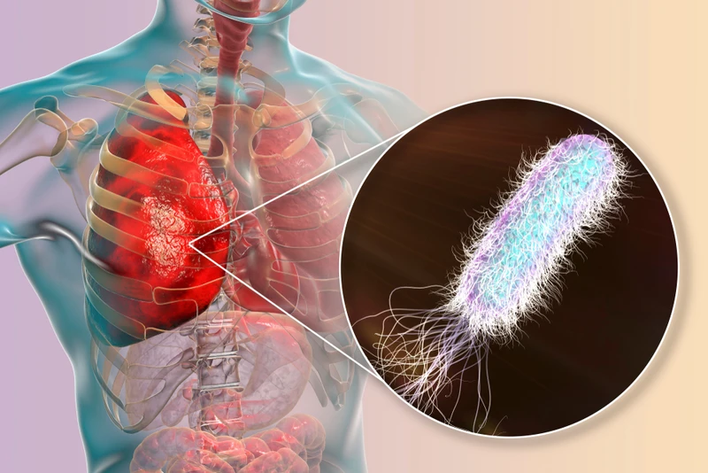 Viêm phổi bệnh viện là gì? Những yếu tố làm tăng nguy cơ mắc bệnh 3.jpg