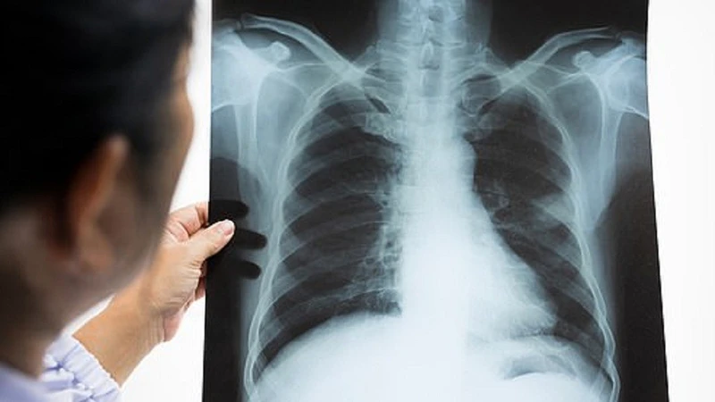 Viêm phổi do virus là gì? Những điều cần chú ý để tránh bệnh tiến triển nặng 5.jpg