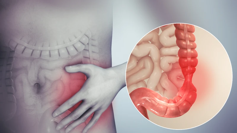 Viêm phúc mạc ruột thừa là gì? Bệnh lý nguy hiểm cần phát hiện sớm 1.jpg