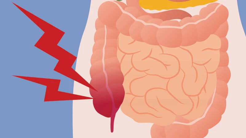Viêm phúc mạc ruột thừa là gì? Bệnh lý nguy hiểm cần phát hiện sớm 2.jpg