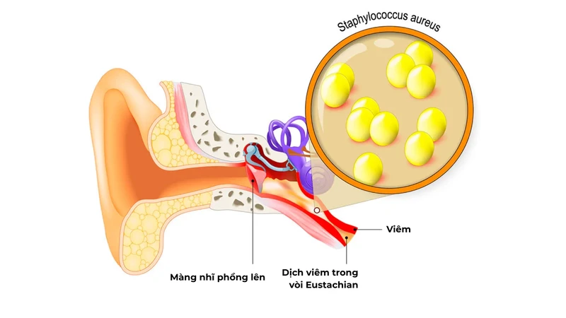 Viêm tai: Triệu chứng, phương pháp điều trị và phòng ngừa 4
