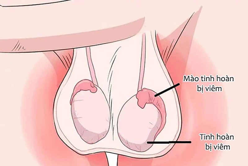 Viêm tinh hoàn do quai bị: Dấu hiệu nhận biết và cách phòng ngừa 2