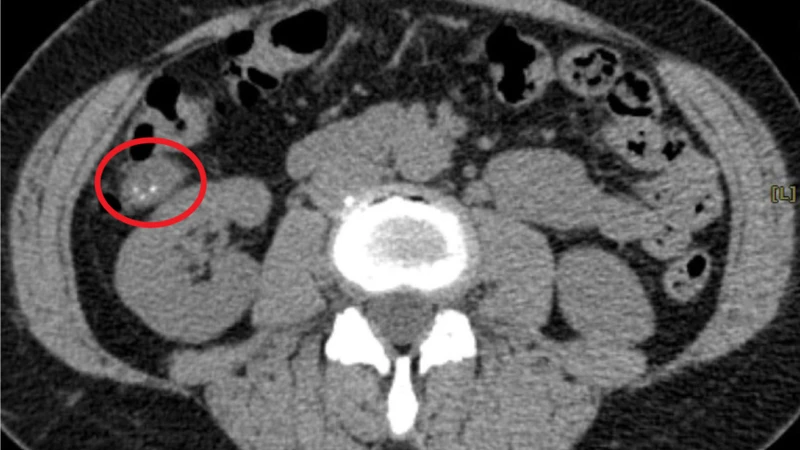 Viêm túi mật là gì? Những vấn đề cần biết về viêm túi mật 3