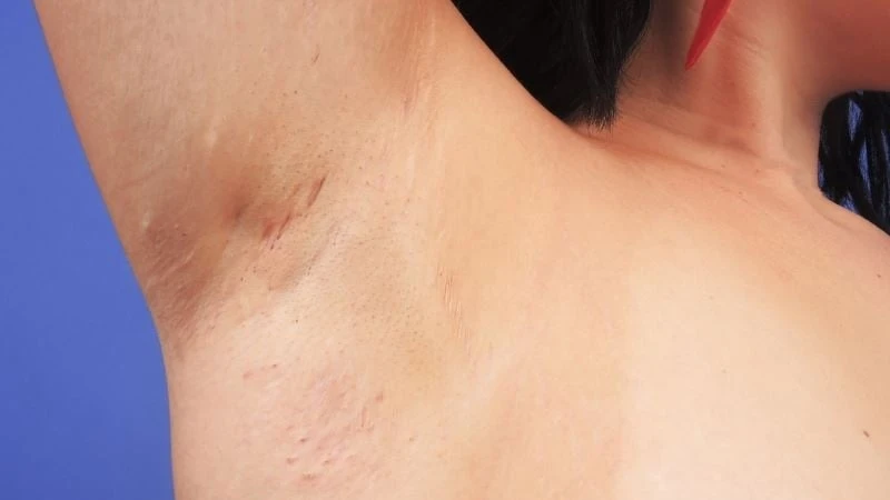 Viêm tuyến mồ hôi mủ là bệnh da liễu mạn tính thường xuất hiện dưới vùng nách, kẽ mông,...