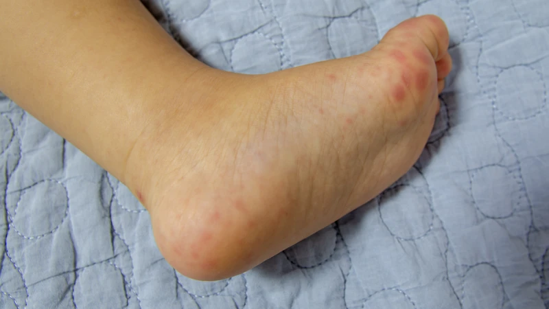 Các nốt phát ban trên da là triệu chứng điển hình của bệnh tay chân miệng