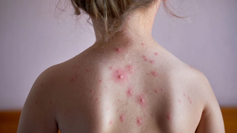 Virus thủy đậu sống bao lâu trong không khí​ và thủy đậu lây nhiễm như thế nào? 3