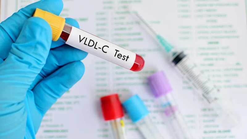 Nồng độ VLDL cao là một yếu tố nguy cơ quan trọng của bệnh tim mạch