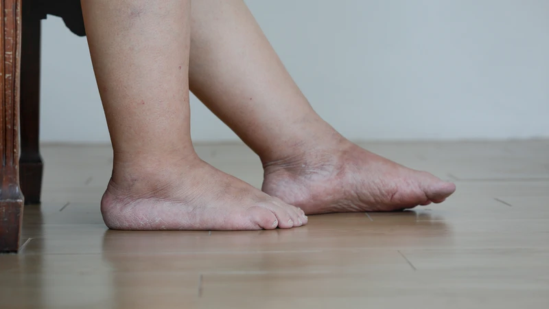 Vớ giãn tĩnh mạch phù hợp với người bị sưng phù, nặng chân hoặc có các vấn đề về tĩnh mạch